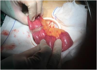 Long-Term outcomes of uncut roux-en-Y anastomosis in laparoscopic distal gastrectomy: A retrospective analysis